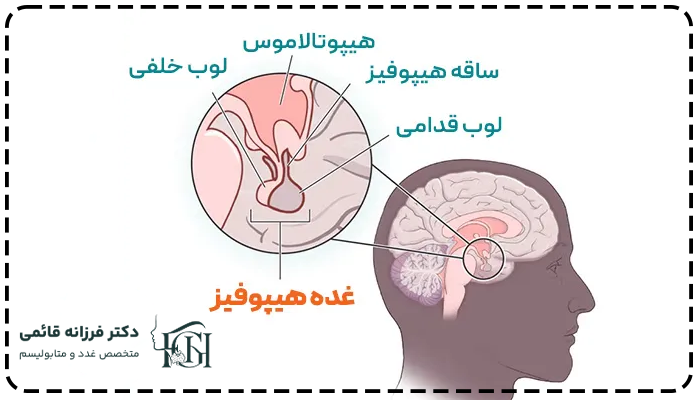 انواع اختلالات غده هیپوفیز