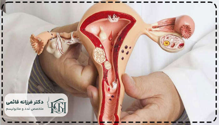 درمان تخمدان پلی کیستیک (PCOS)