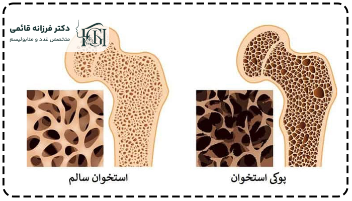 پوکی استخوان چیست