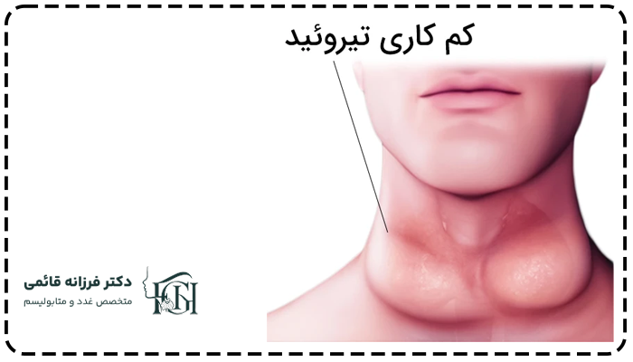 کام کاری تیروئید