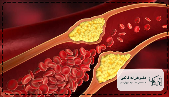 کنترل چربی خون بالا