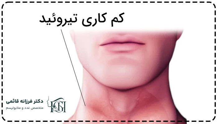 کم کاری تیروئیدچیست