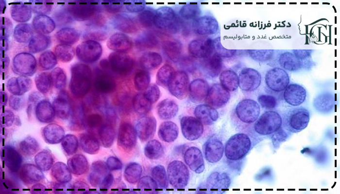 سرطان تیروئید پاپیلاری