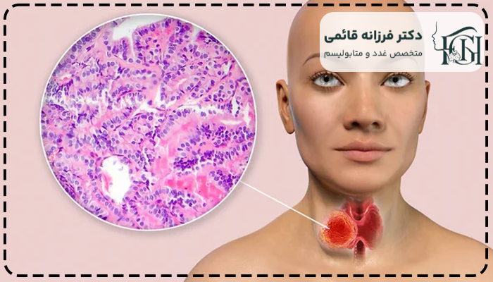 سرطان پاپیلاری تیروئید بدخیم