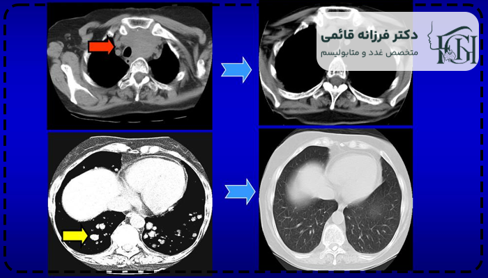 سرطان پاپیلاری تیروئید