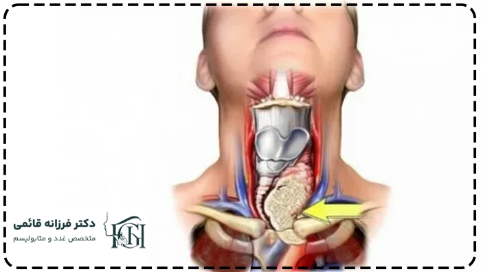 علائم سرطان آناپلاستیک