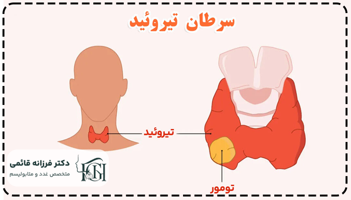 علائم سرطان تیروئید