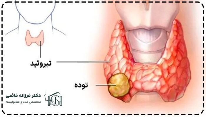 علت سرطان تیروئید
