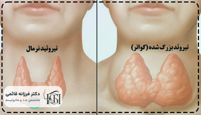 گواتر چیست