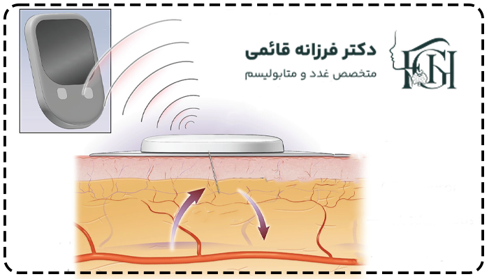 سنسور قند خون چیست