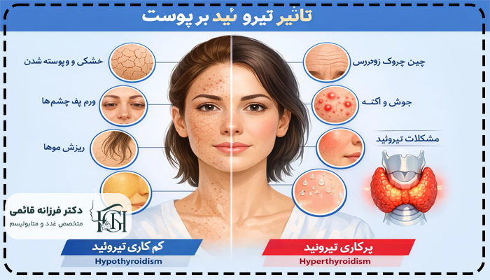 پرکاری تیروئید و لکه های پوستی